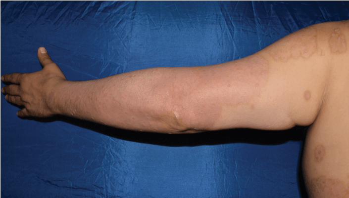 See transformative skin clearance3,4,6  Week 4  PASI 75