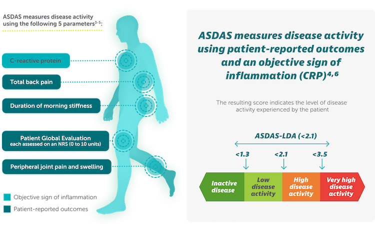 ASDAS: a composite index used to assess disease activity.