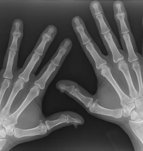 X-Ray